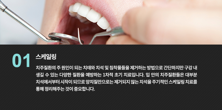 -스케일링
치주질환의 주 원인이 되는 치태와 치석 및 침착물들을 제거하는 방법으로 간단하지만 구강 내 생길 수 있는 다양한 질환을 예방하는 1차적 초기 치료입니다. 입 안의 치주질환들은 대부분 치석에서부터 시작이 되므로 양치질만으로는 제거되지 않는 치석을 주기적인 스케일링 치료를 통해 정리해주는 것이 중요합니다.
